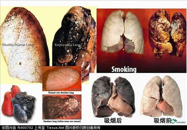 恐怖贴:看看吸烟者的肺!